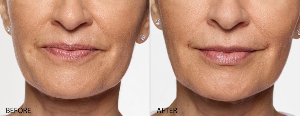 Restylane® Silk Before and After Pictures Pflugerville, TX