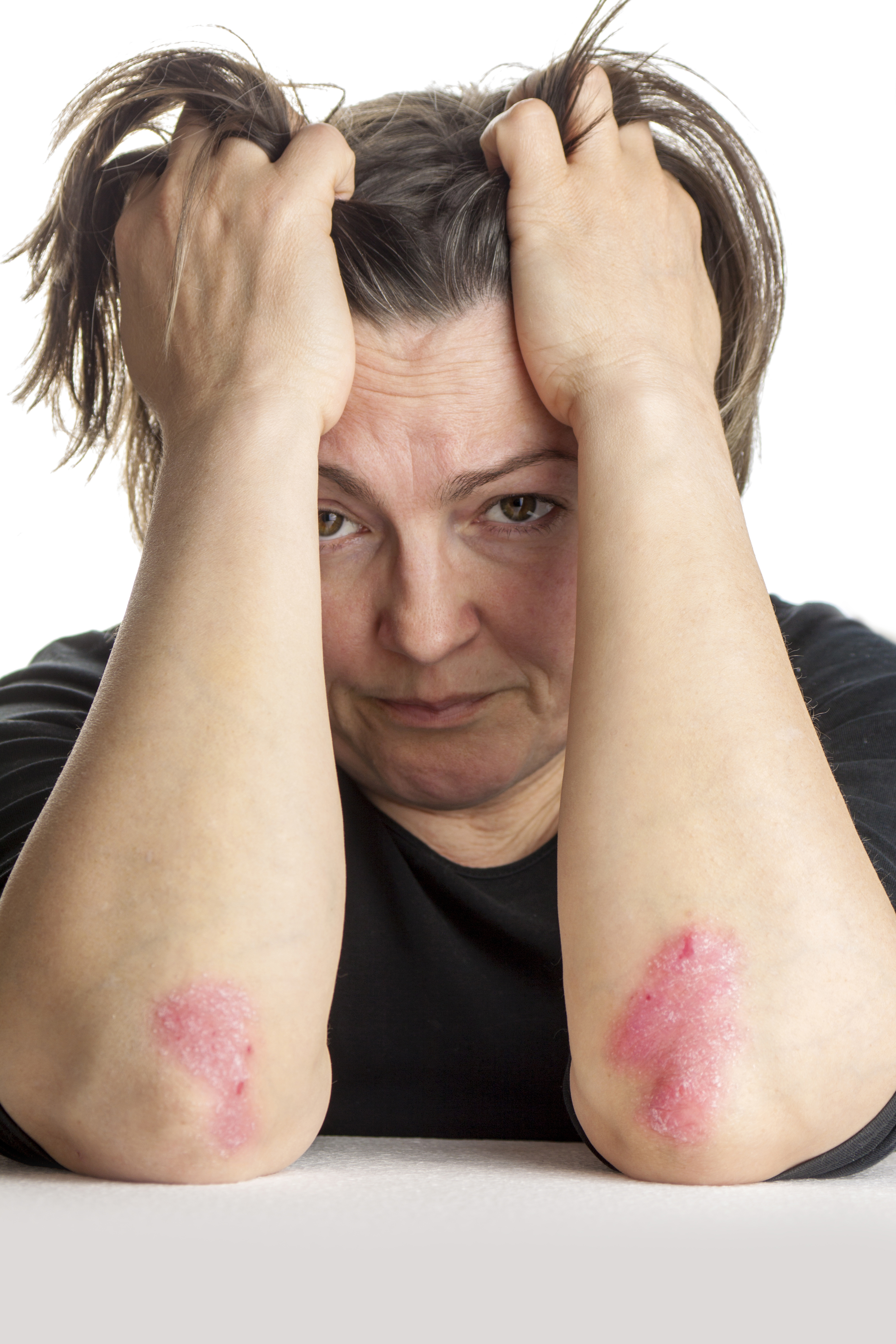 The Emotional Effects of Psoriasis