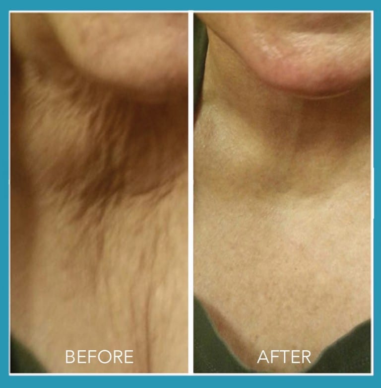 Micro-Needling For Skin Tigthening