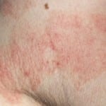 What is Allergic Contact Dermatitis?