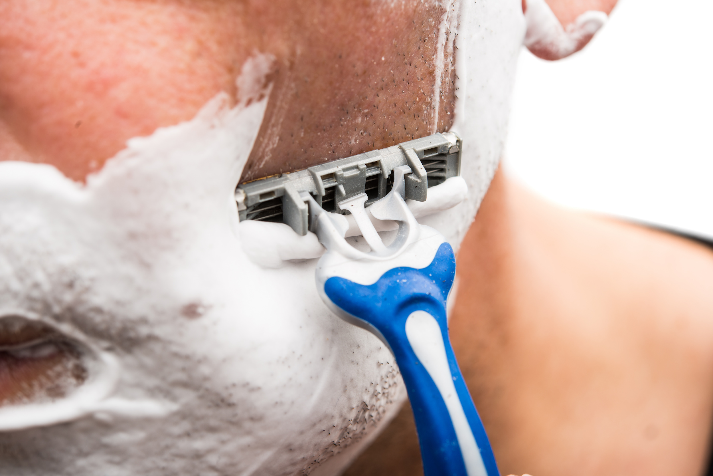 Razor Bumps: Why Shaving Technique is Key to Avoiding Skin Irritation of Pseudofolliculitis Barbae