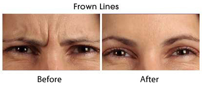 BOTOX® Cosmetic Before and After Pictures Pflugerville, TX