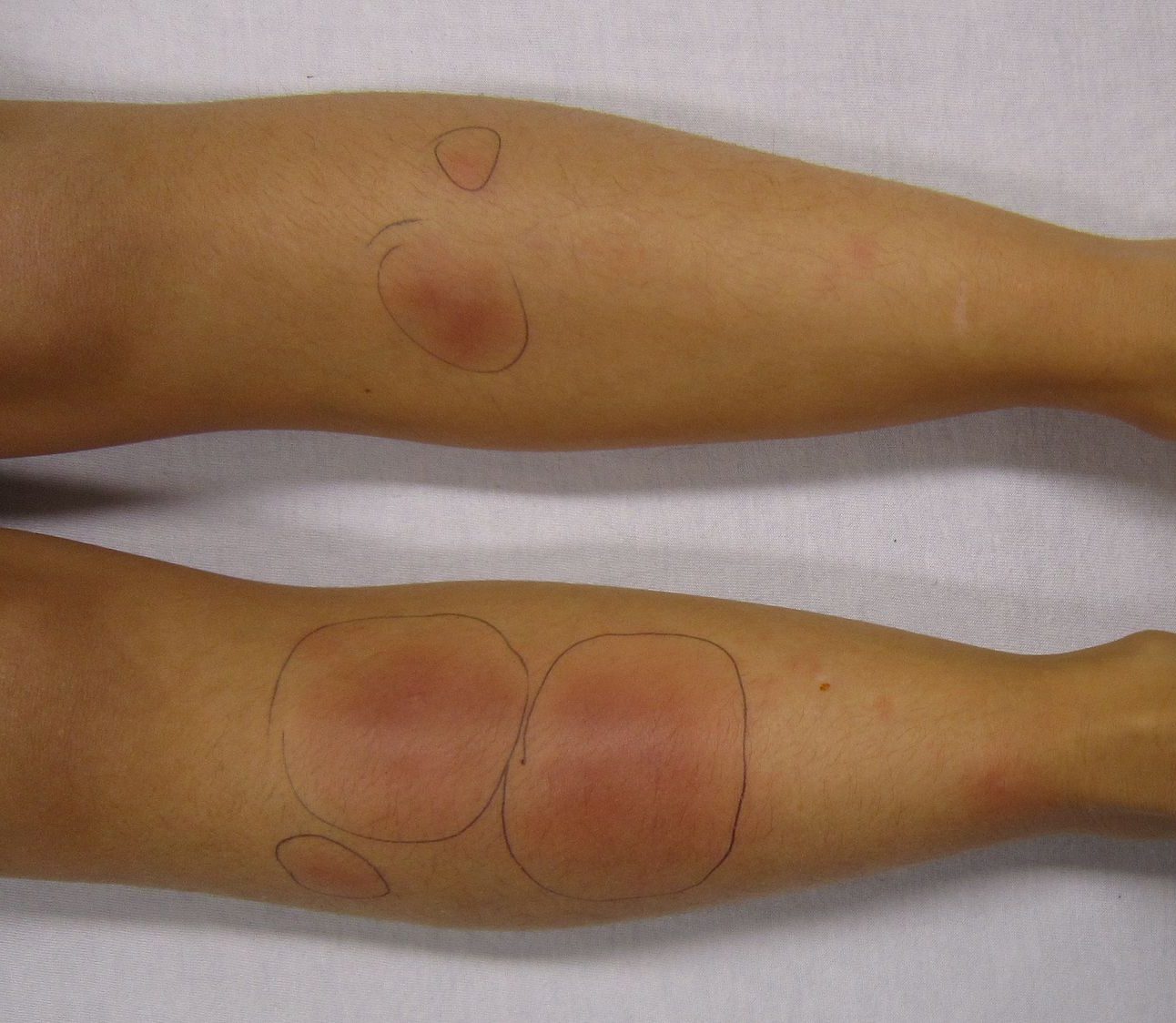 Skin Disorders : Erythema Nodosum