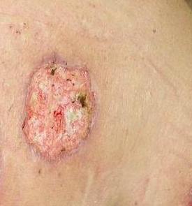 What You Need To Know About Pyoderma Gangrenosum