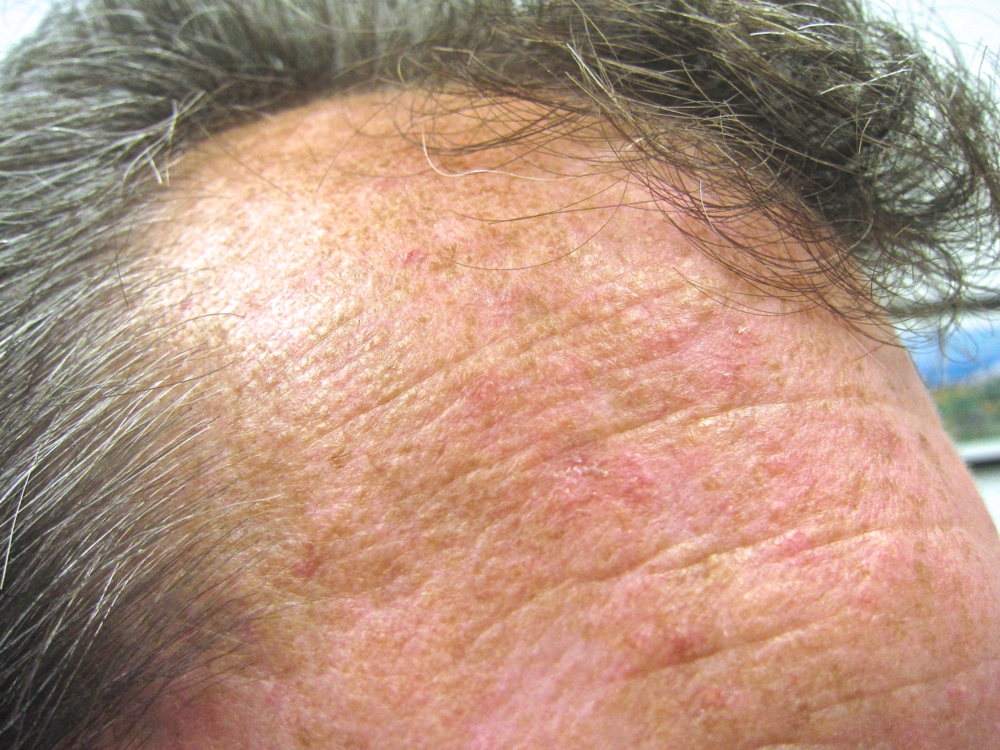 Actinic Keratosis in Austin, TX