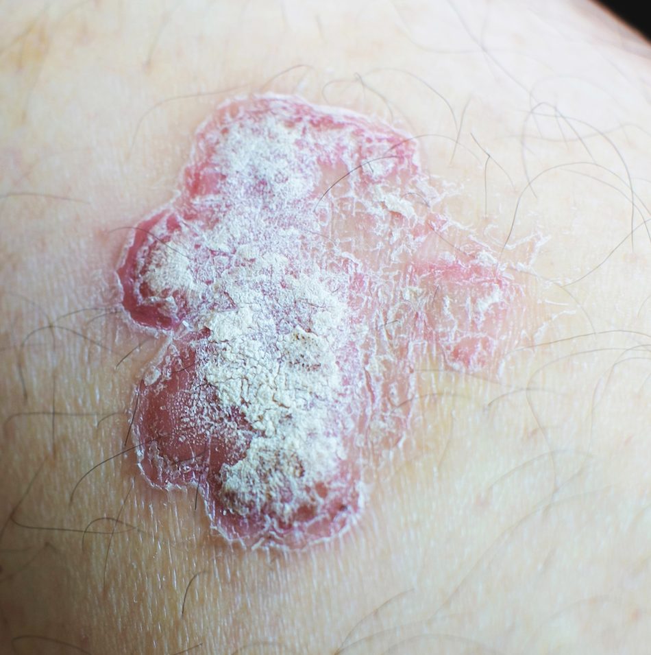 Siliq for the Treatment Of Psoriasis