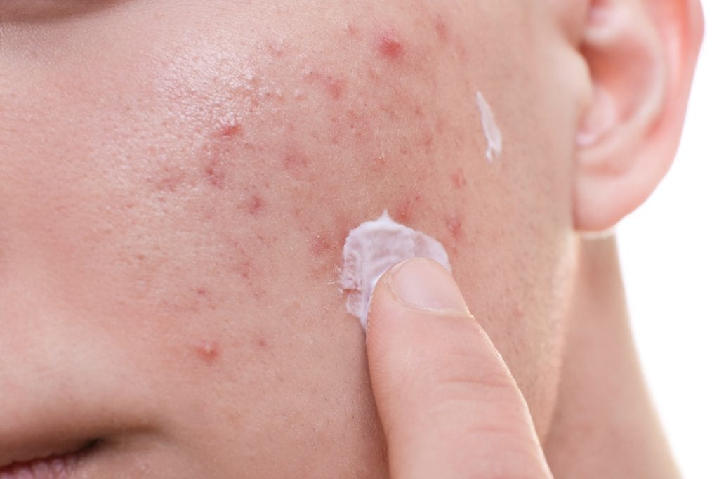 topical-antibiotics-for-treating-acne