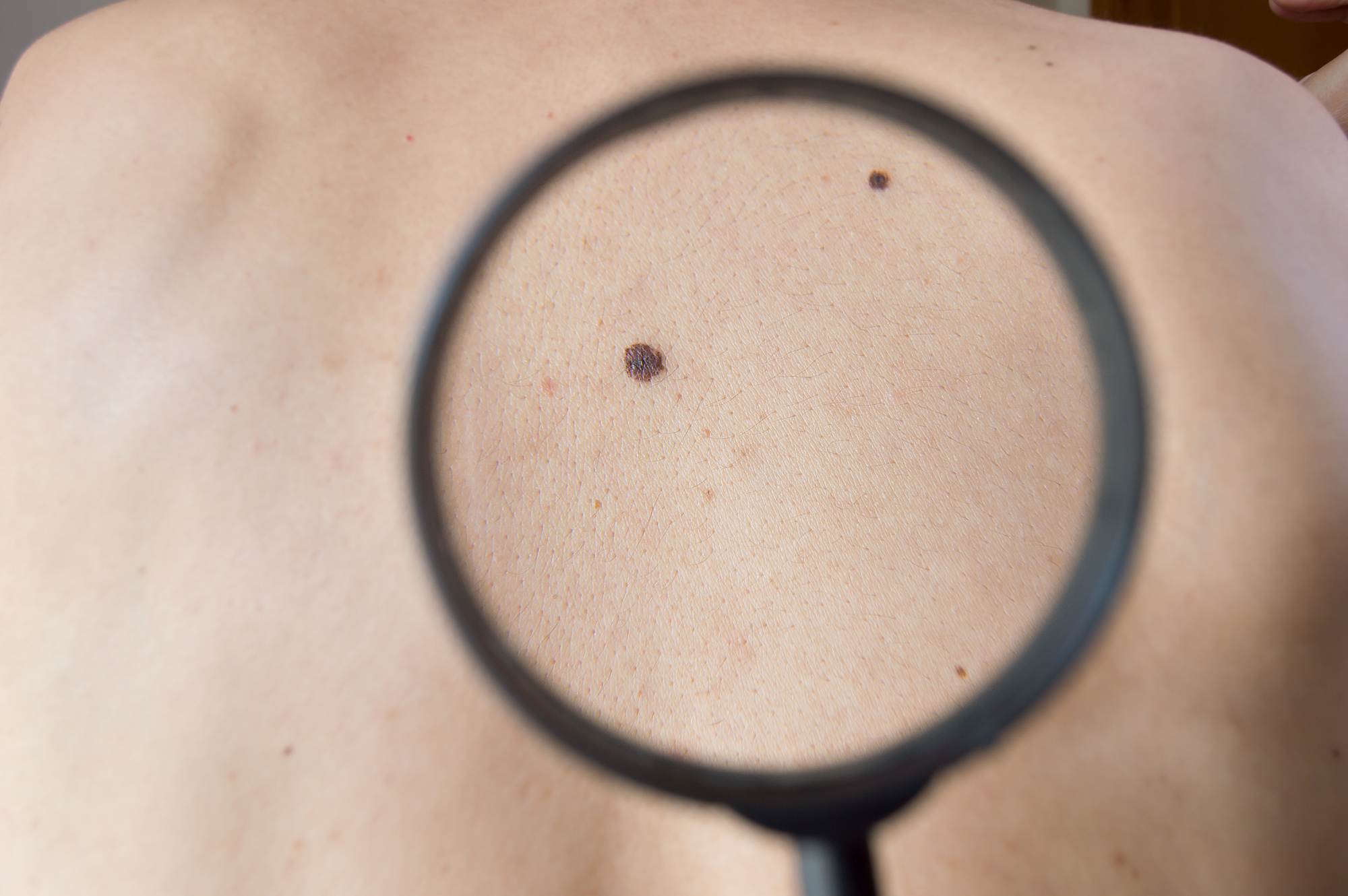 Skin Cancer Treatment in Austin, TX