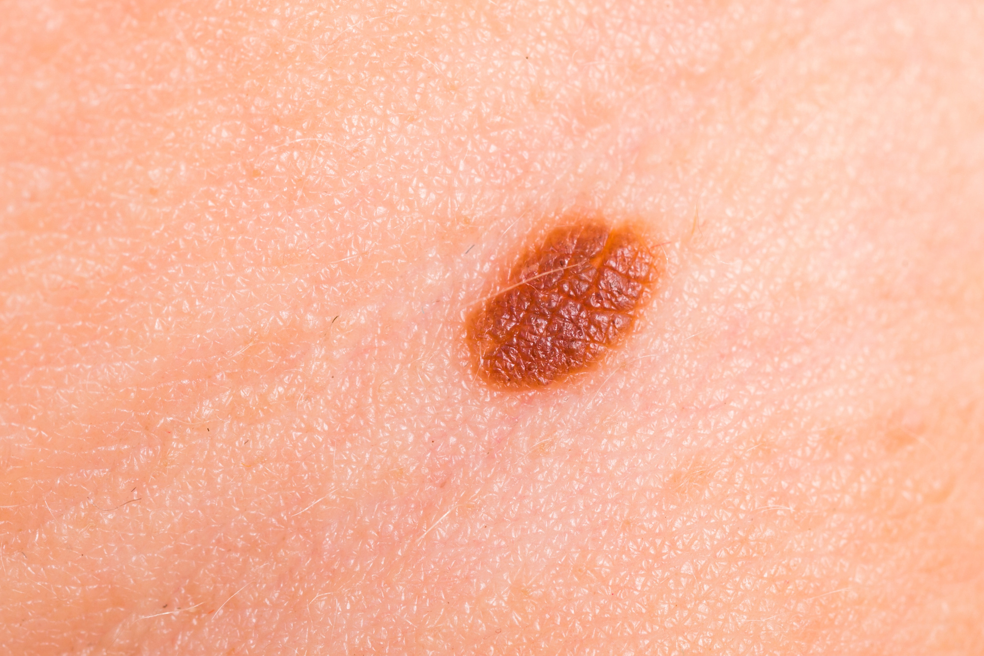The ABC’s of Skin Cancer Detection