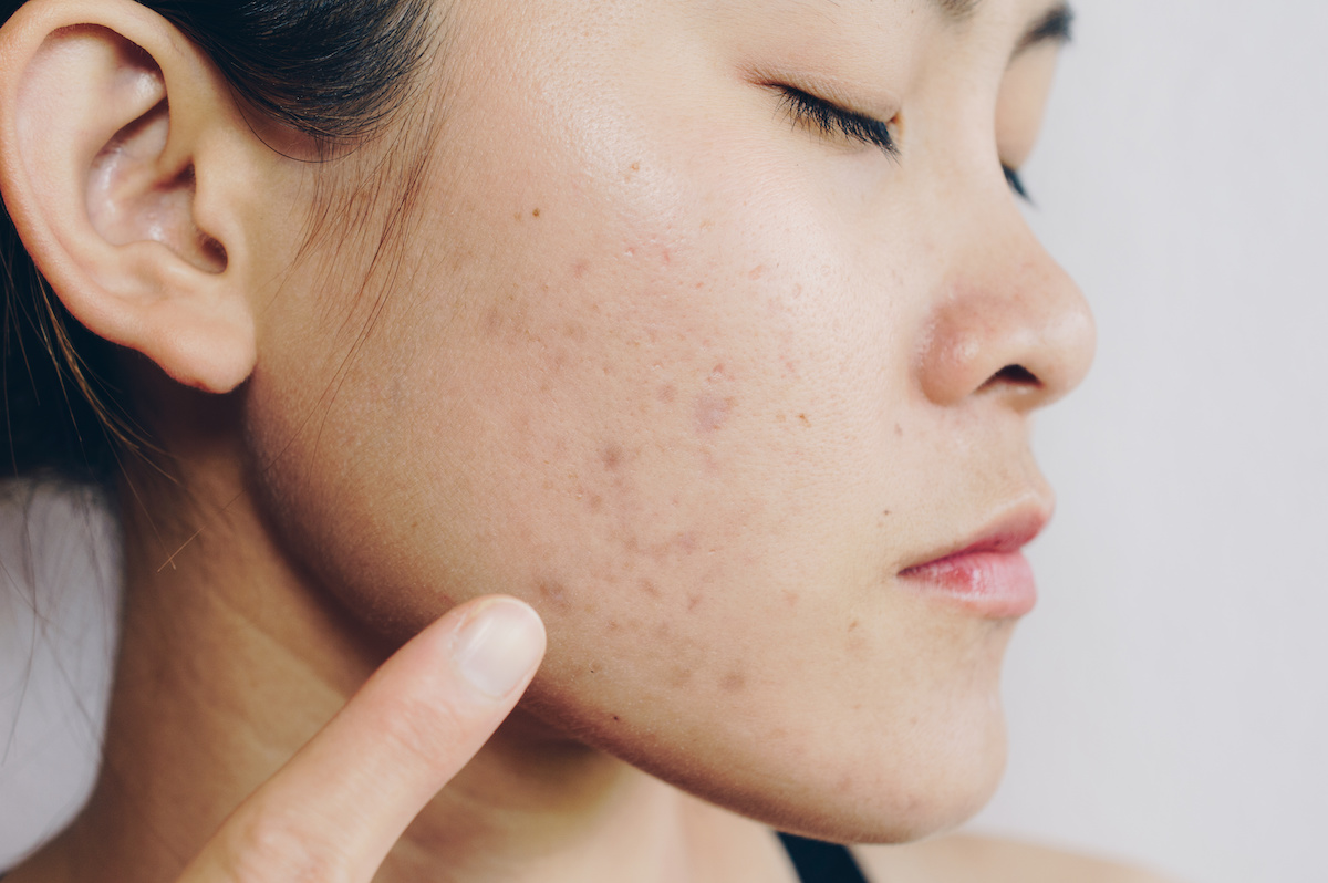 Taking Care Of Your Skin After Laser Scar Reduction