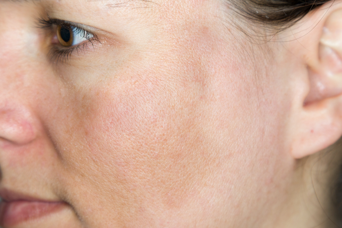 Hyperpigmentation Vs Hypopigmentation