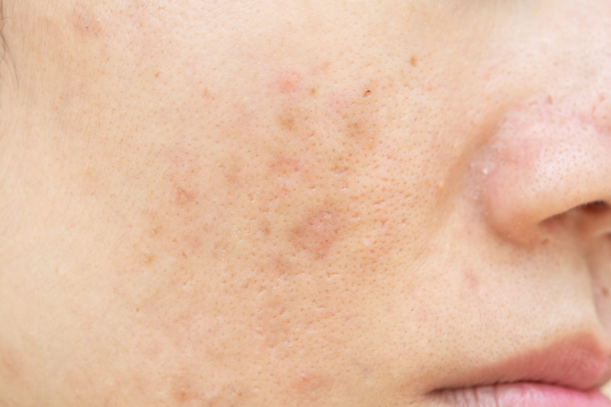 Acne Treatment in Austin, TX