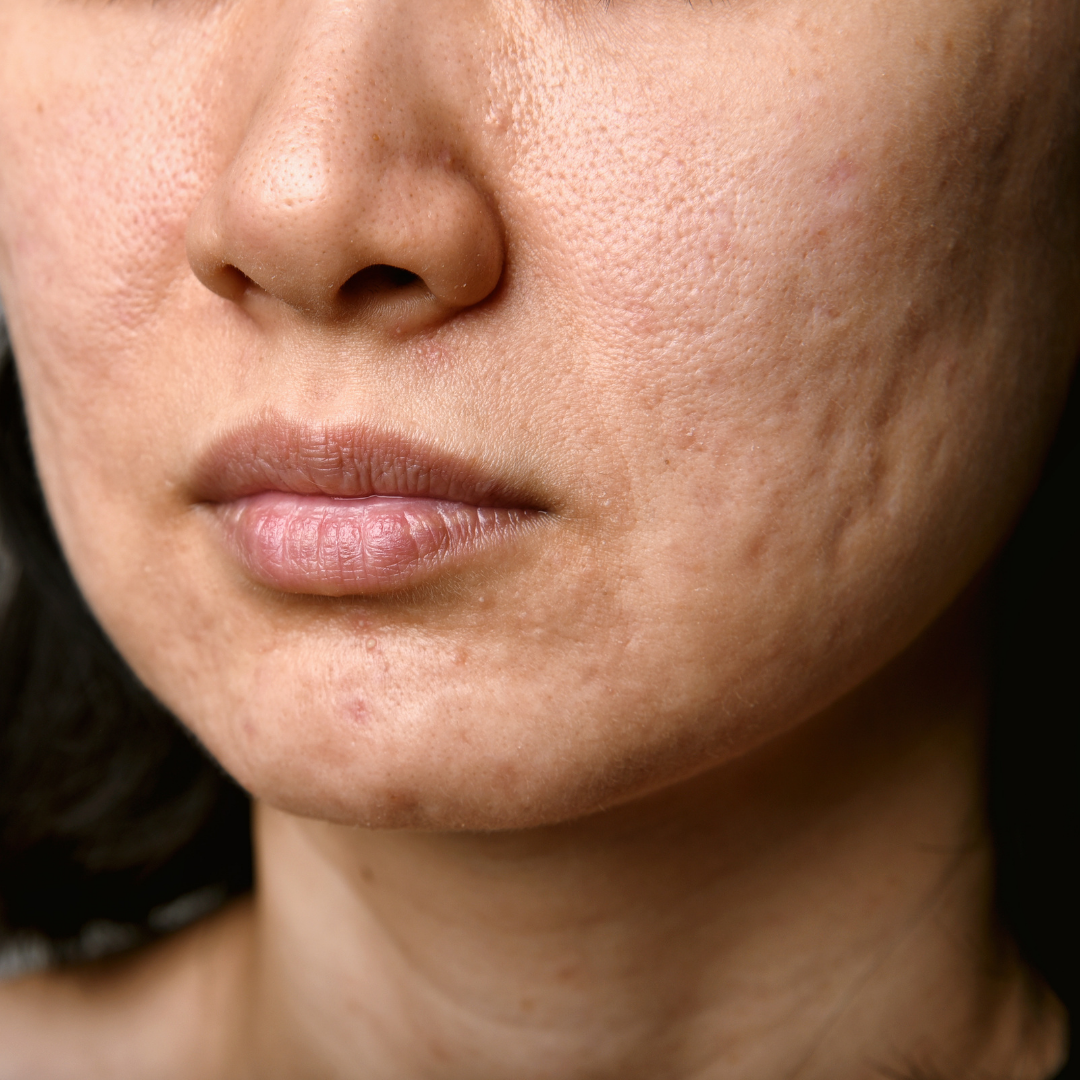 How to Treat Acne Scars with the Spectra Laser