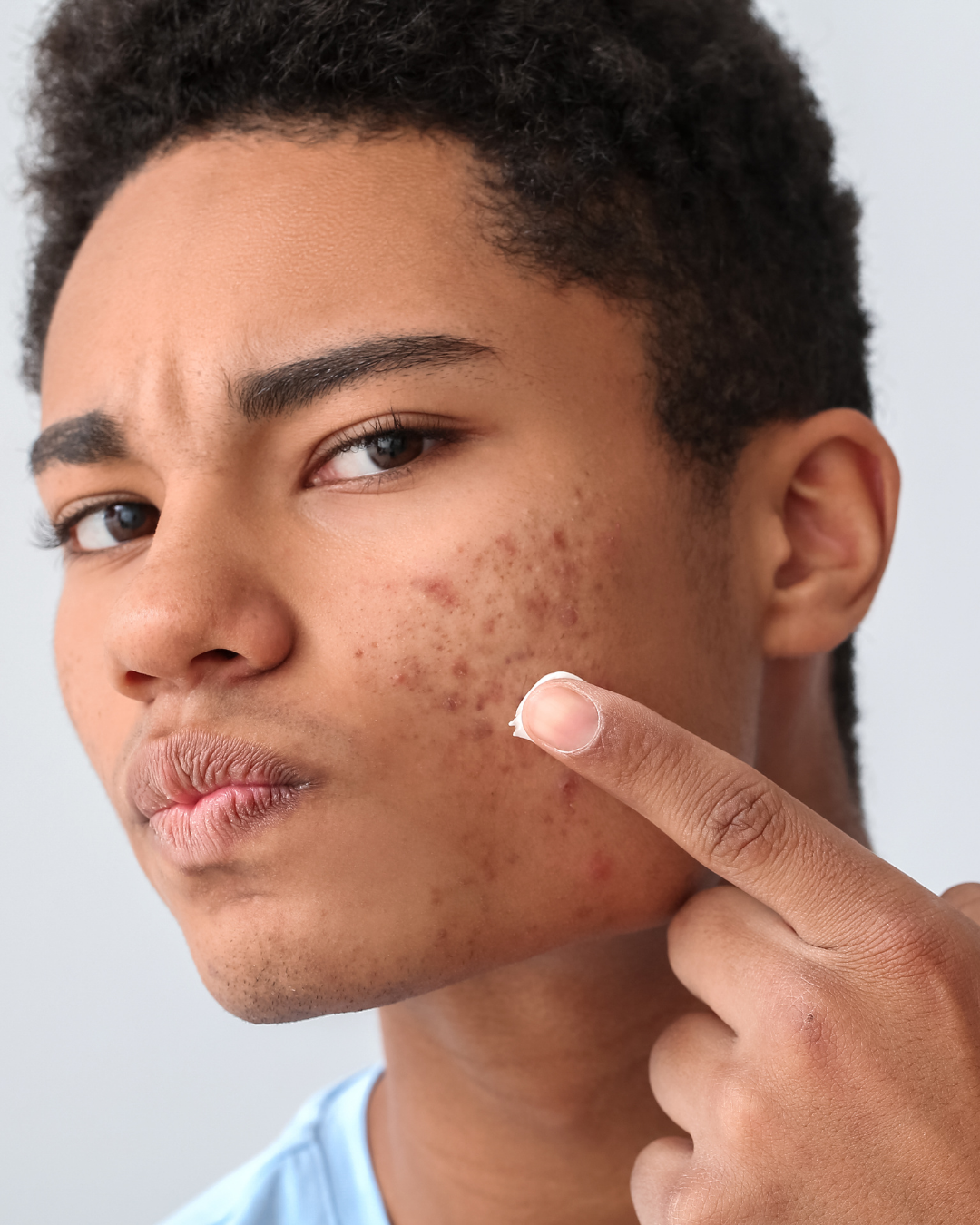 What Causes My Acne?