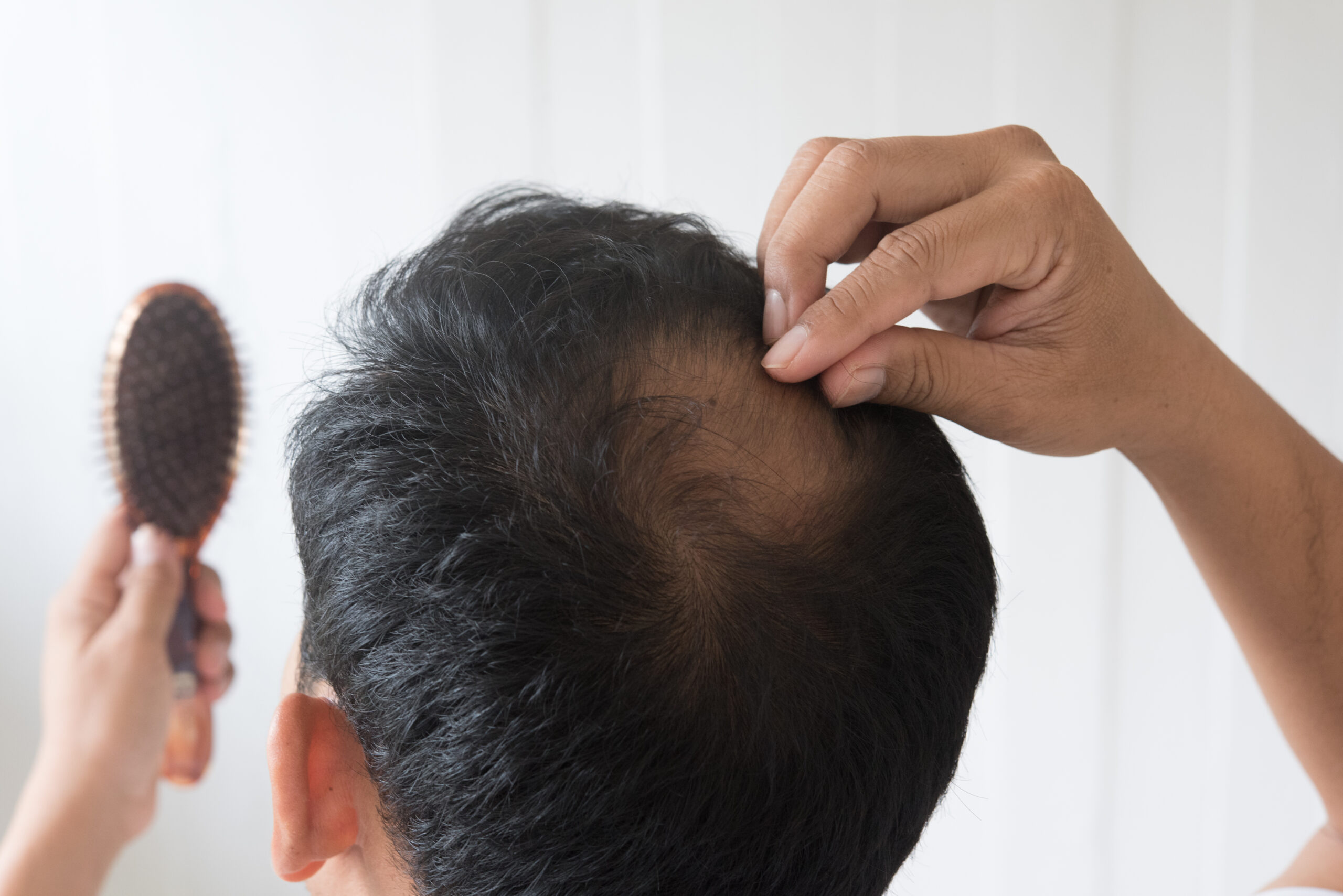 The Thing About Men’s Hair Loss