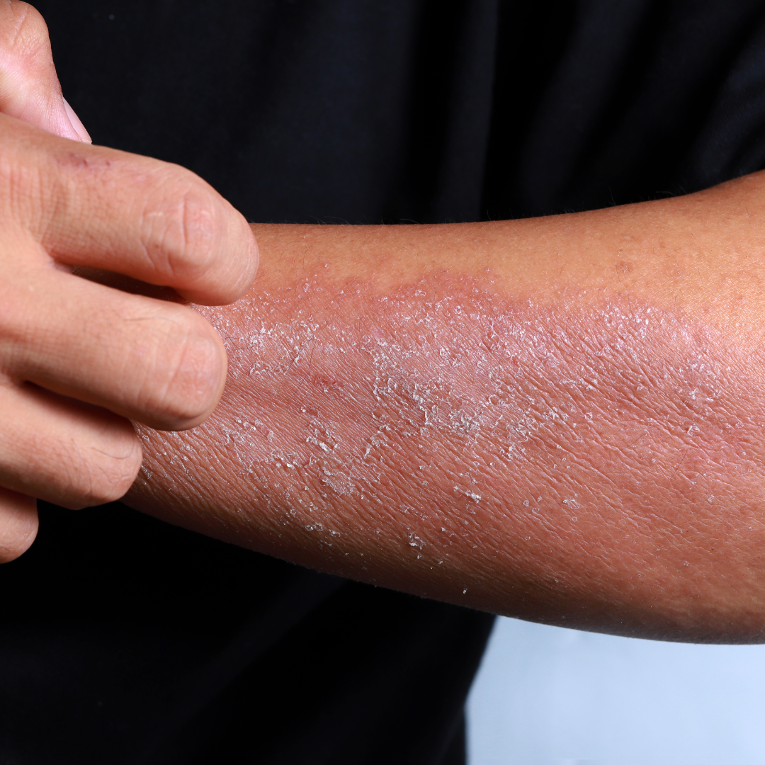 Eczema: Who is Affected and What You Need to Know