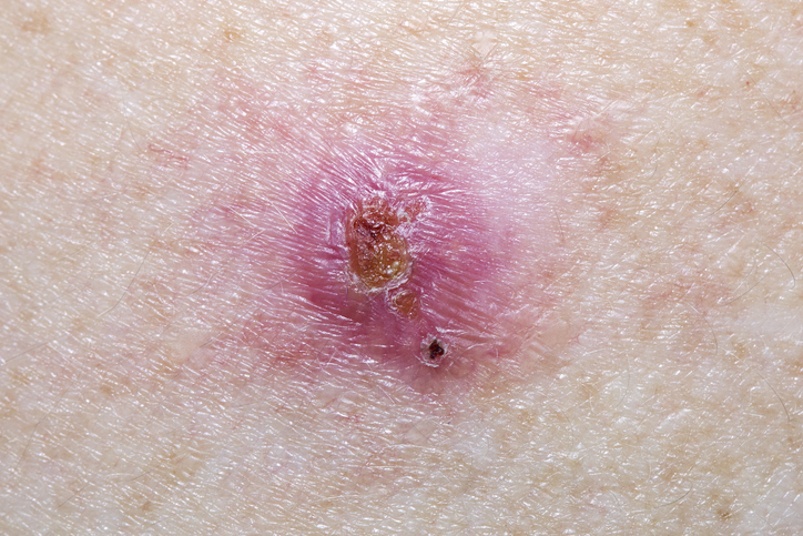 Basal Cell Carcinoma