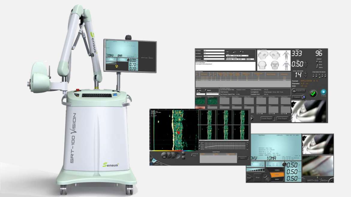 Superficial Radiation Therapy (SRT)