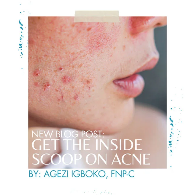 Get the Inside Scoop on the Types of Acne and How to Deal with Them!